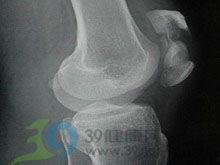 成人骨折拆石膏视频,成人骨折石膏拆除操作演示