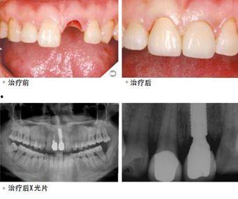 成人牙自动脱落视频大全,震撼视频大全